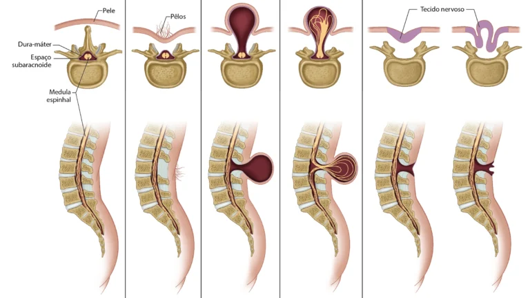 Ilustração esquemática dos tipos de espinha bífida na coluna vertebral