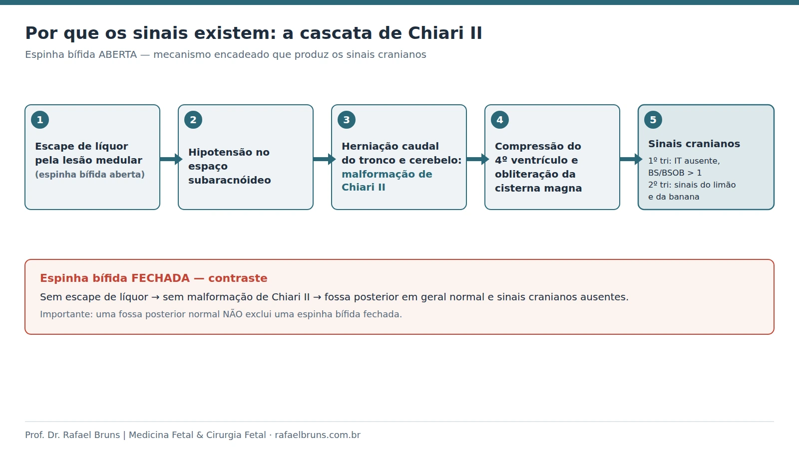Diagrama da cascata da malformação de Chiari II na espinha bífida aberta: escape de líquor, hipotensão subaracnóidea, herniação caudal, compressão do quarto ventrículo e sinais cranianos; na forma fechada a fossa posterior é preservada