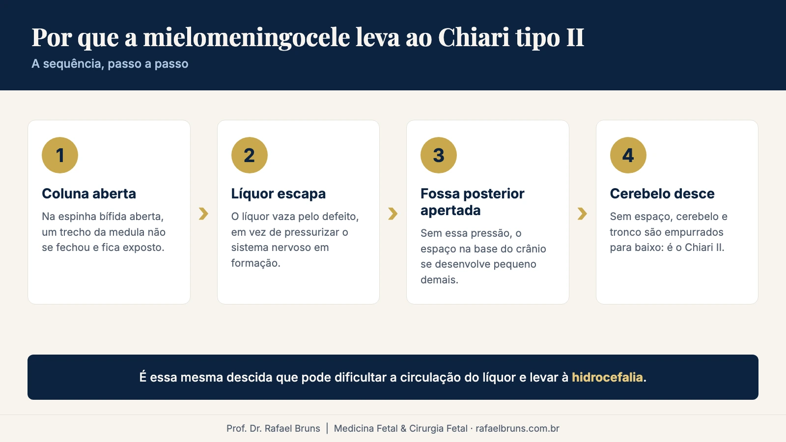 Sequência em quatro passos de como a espinha bífida aberta leva ao Chiari tipo II: coluna aberta, vazamento de líquor, fossa posterior pequena e descida do cerebelo