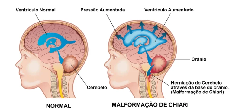 Esquema comparativo: cérebro normal à esquerda e malformação de Chiari com herniação do cerebelo e ventriculomegalia à direita