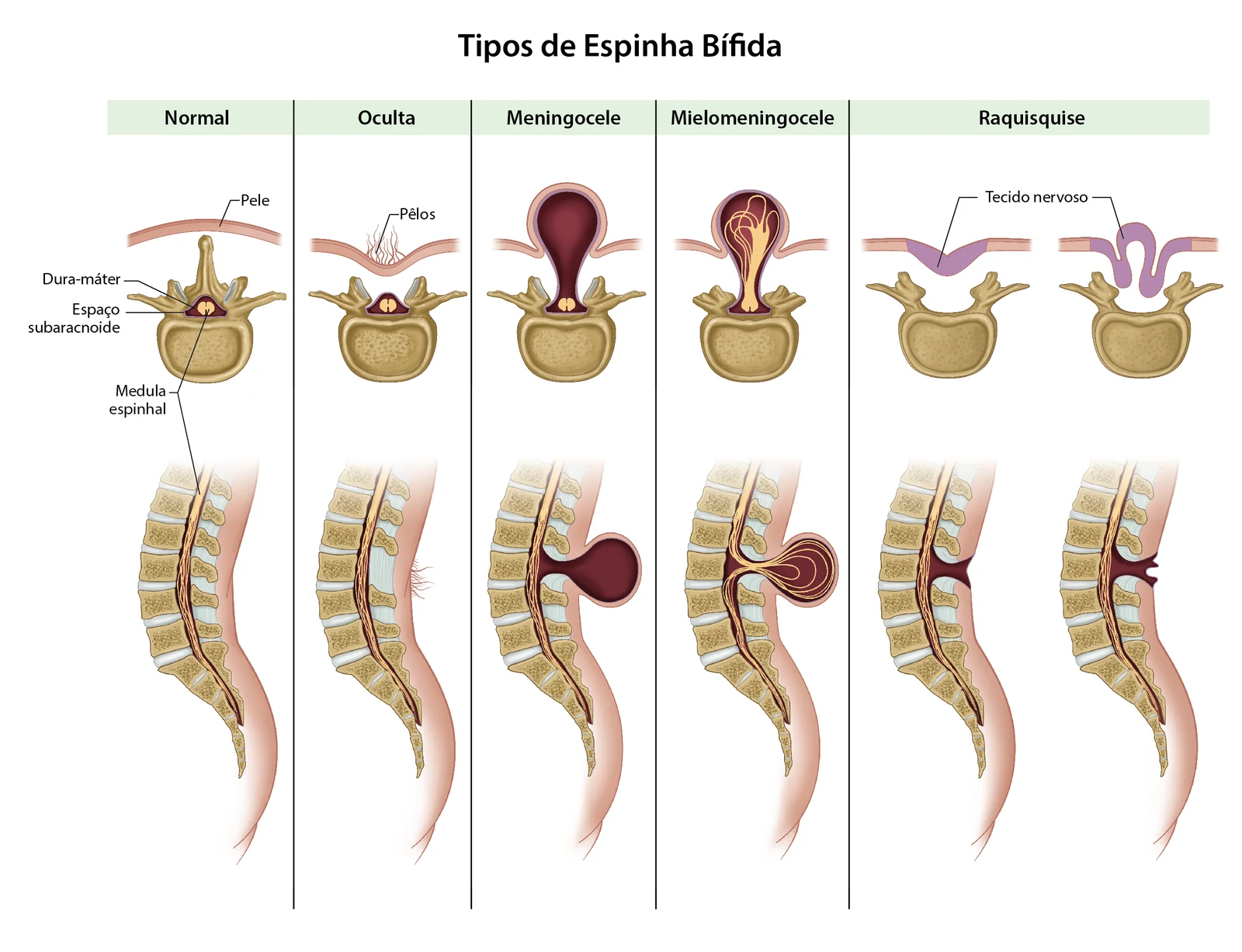 Comparação dos tipos de espinha bífida na coluna: normal, oculta, meningocele, mielomeningocele e raquisquise
