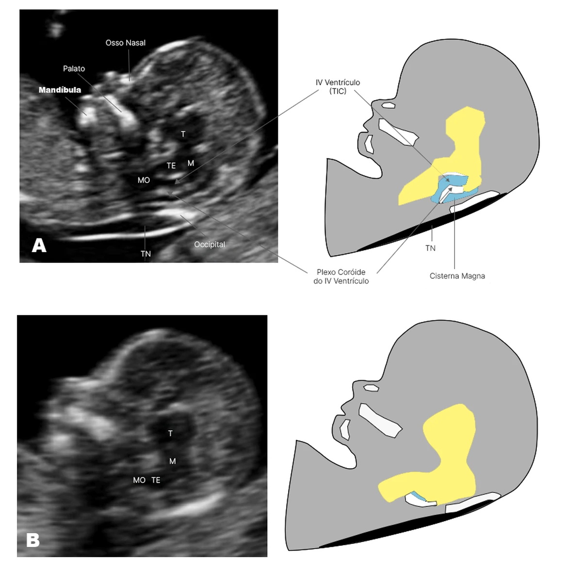 Translucência intracraniana no plano sagital: presente no feto normal e ausente na espinha bífida aberta, com ultrassom e esquema correspondente