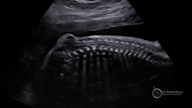 Ultrassom fetal mostrando a coluna e a herniação na mielomeningocele, sinal de espinha bífida aberta