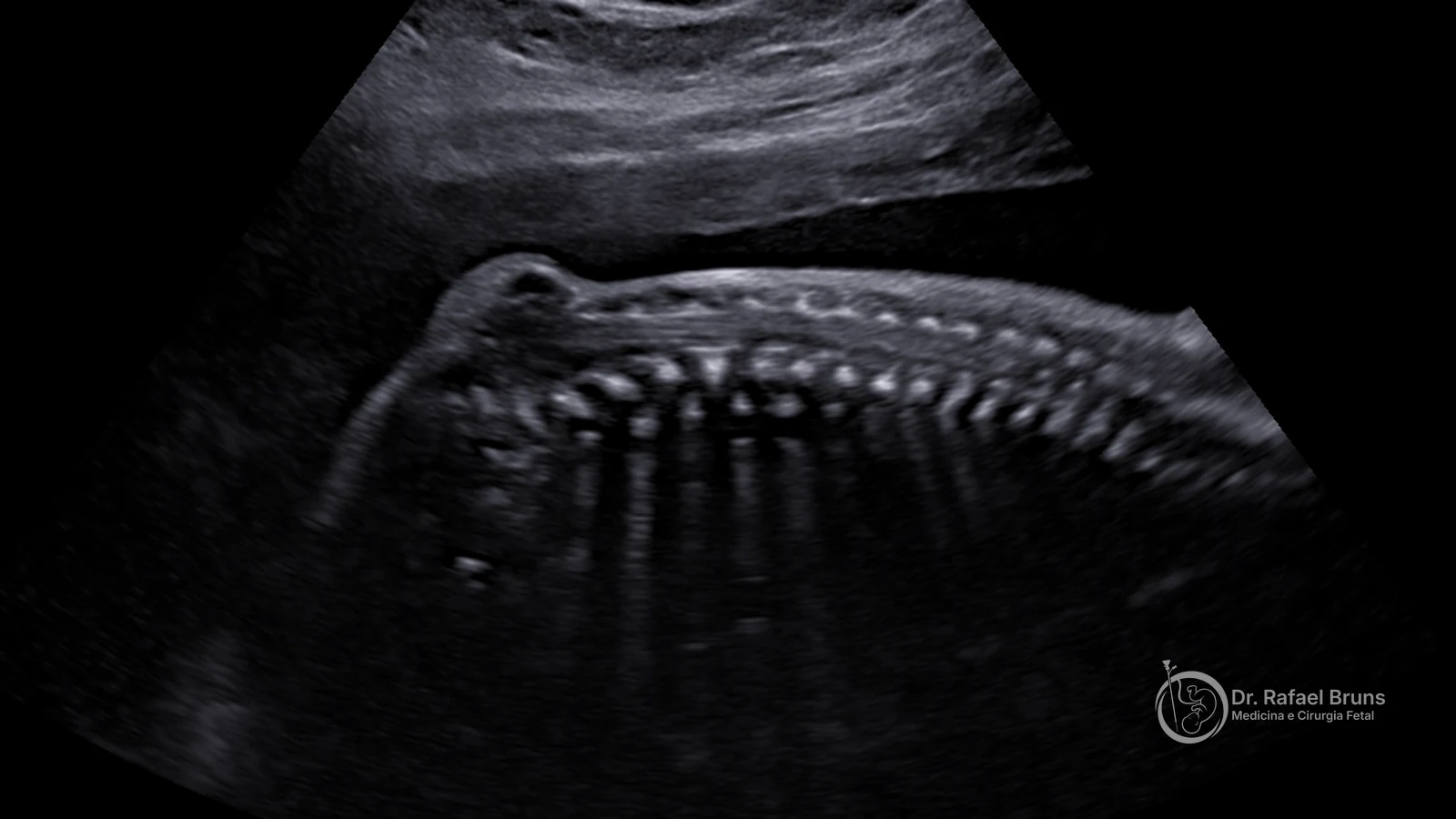 Sinais ultrassonográficos da espinha bífida fetal: do rastreio precoce ao diagnóstico clássico