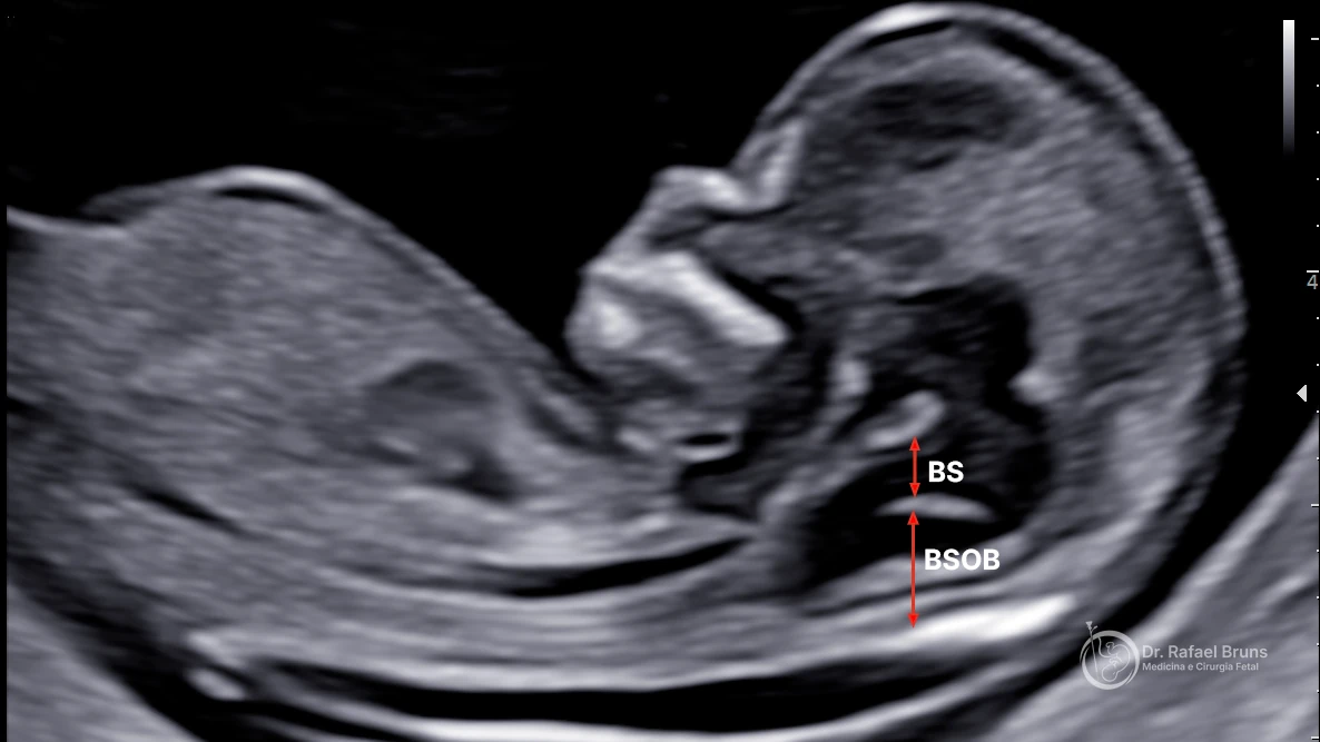 Ultrassom no plano sagital mostrando a medida do tronco encefálico (BS) e da distância tronco-occipital (BSOB) no rastreio de espinha bífida aberta no primeiro trimestre