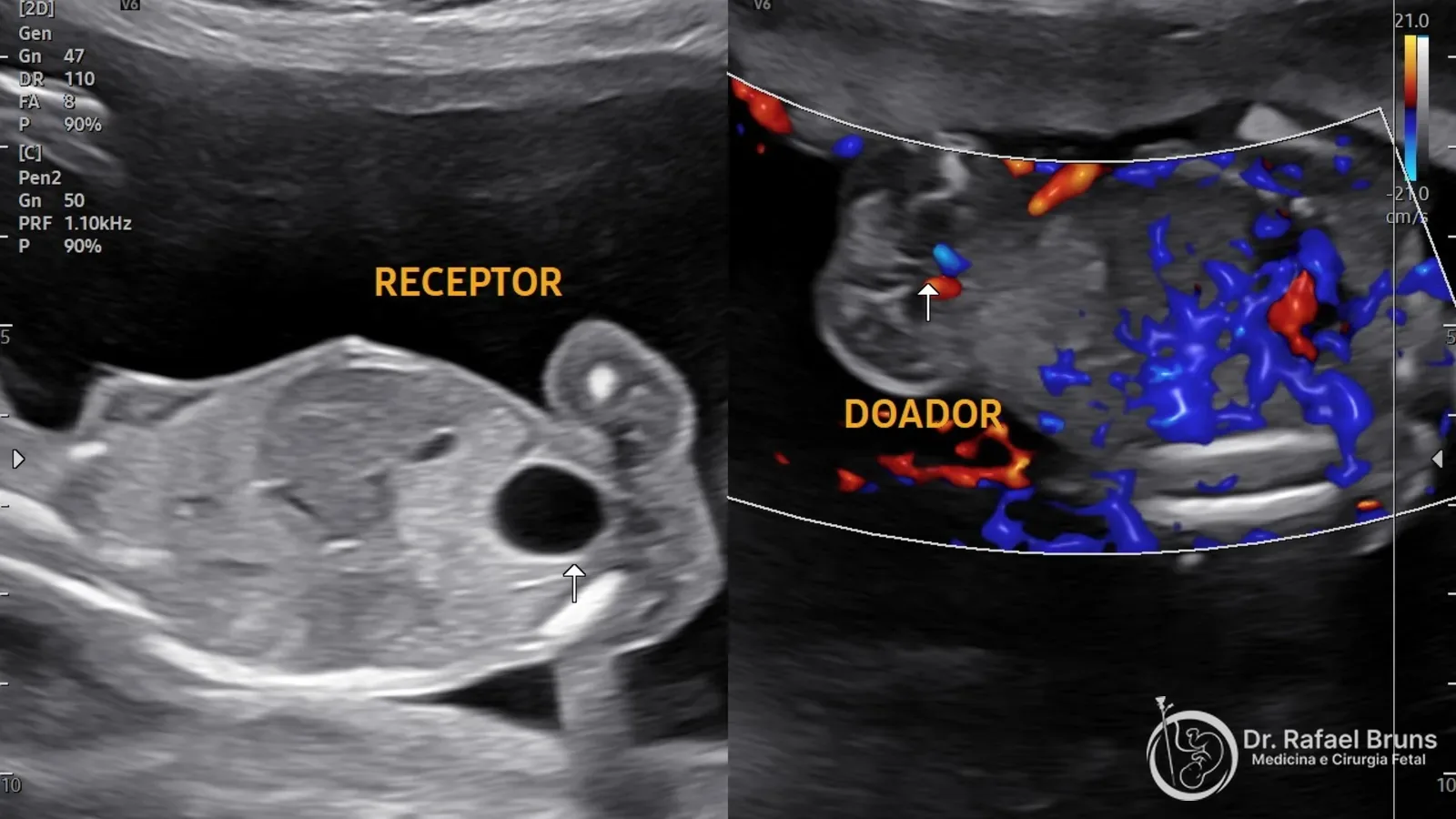 Ultrassom de gestação gemelar monocoriônica mostrando diferença de líquido amniótico entre os fetos — sinal de síndrome de transfusão feto-fetal