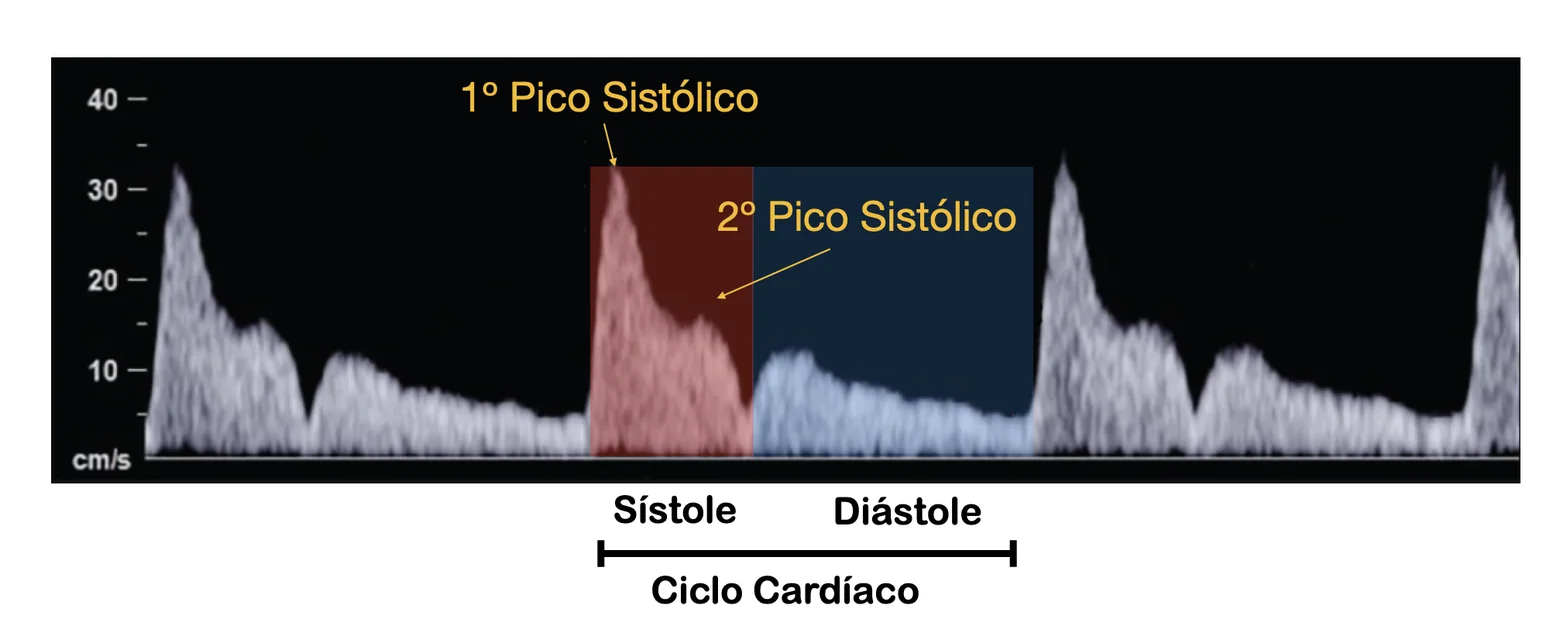 Diagrama do Doppler da artéria oftálmica mostrando o primeiro e o segundo pico sistólico, cuja relação (PSV ratio) é usada para estimar o risco de pré-eclâmpsia