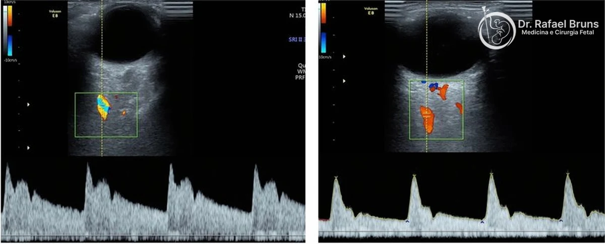 Ultrassom com Doppler da artéria oftálmica materna: mapeamento colorido do vaso e onda espectral com dois picos sistólicos