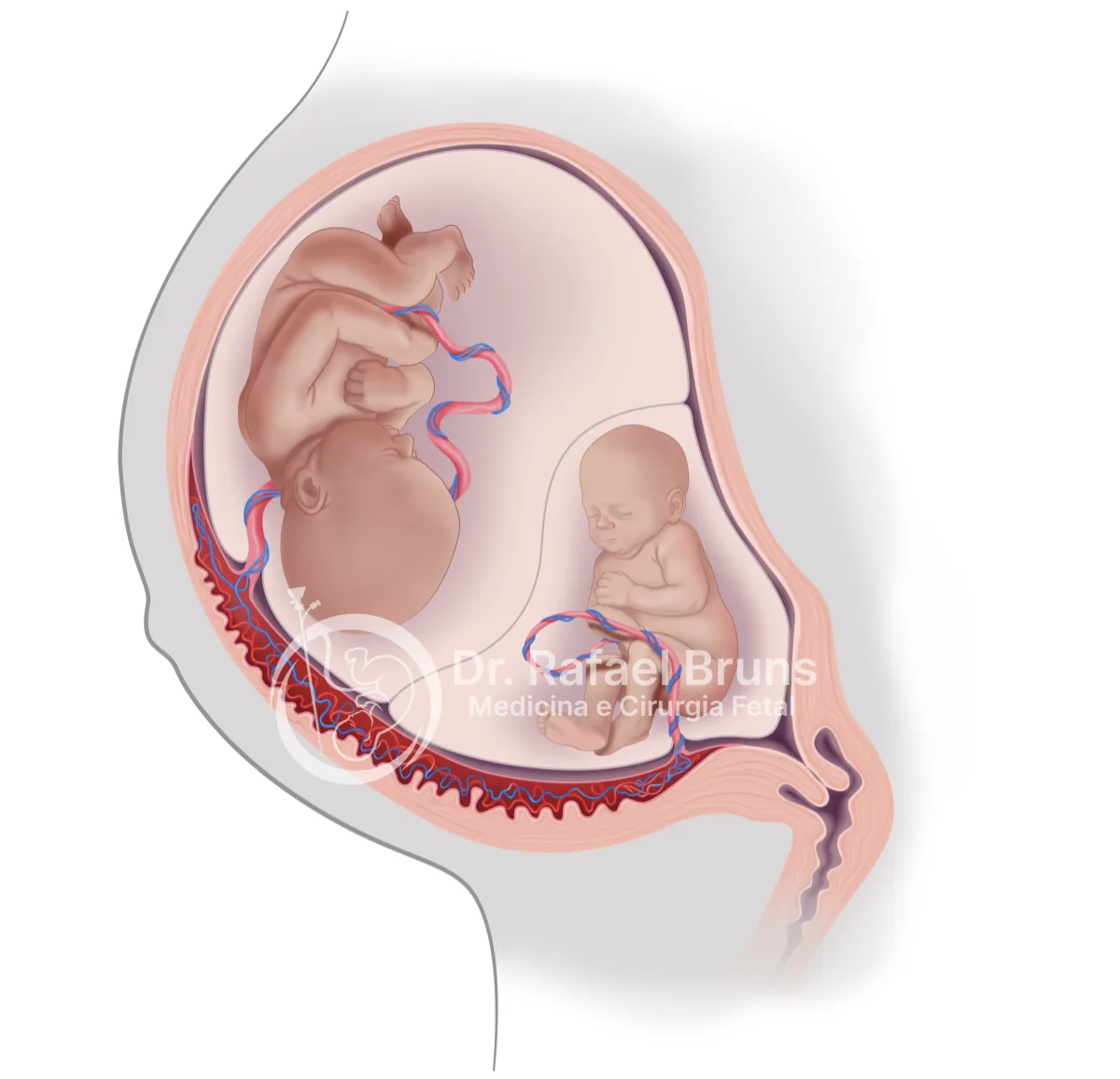 Ilustração de útero com dois gêmeos de tamanhos claramente diferentes, representando a restrição de crescimento seletiva
