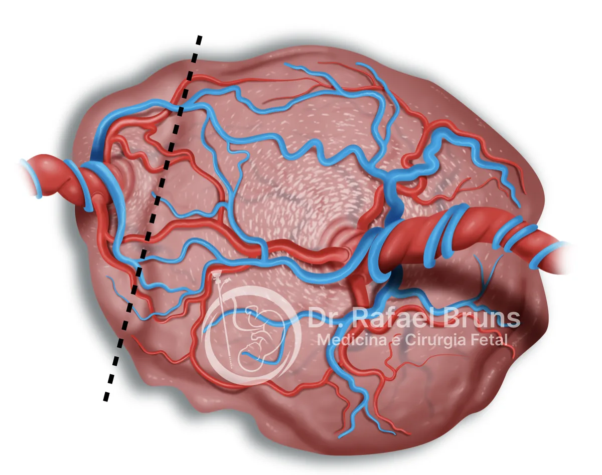 Ilustração de placenta monocoriônica compartilhada de forma desigual, com anastomoses vasculares entre os dois gêmeos