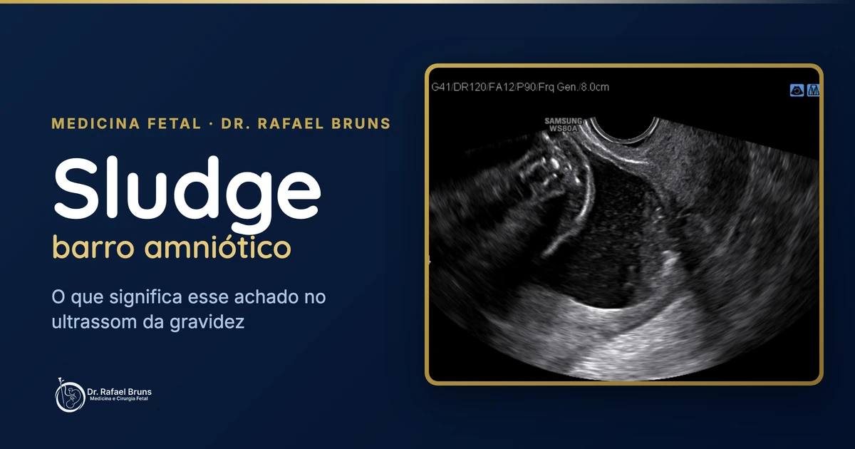 Sludge (barro amniótico): o que significa esse achado no ultrassom e quando ele preocupa
