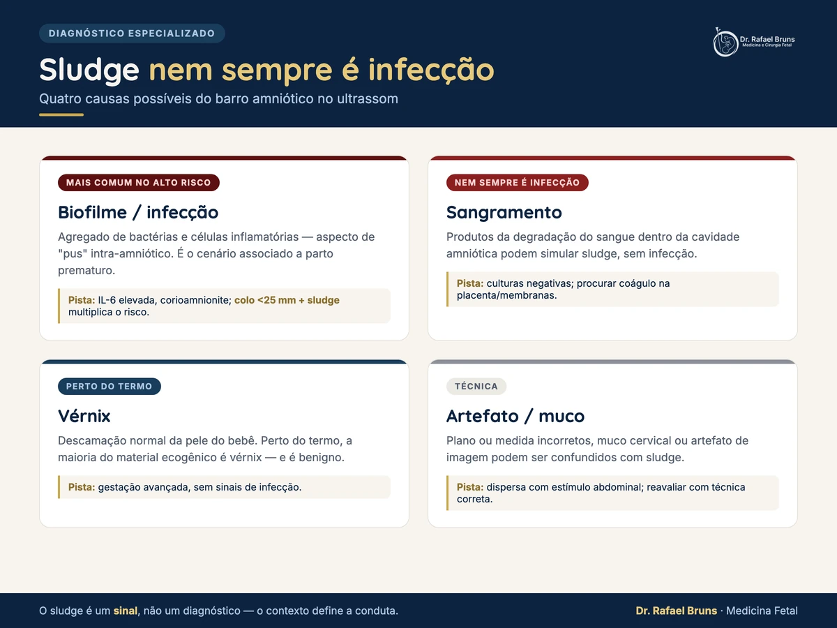 Infográfico: o sludge (barro amniótico) nem sempre é infecção — quatro causas possíveis (biofilme/infecção, sangramento intra-amniótico, vérnix a termo, artefato ou muco)