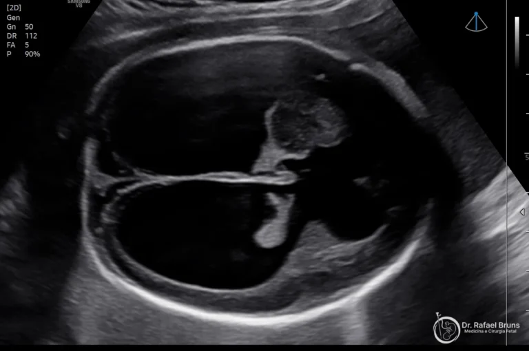 Ultrassom de ventriculomegalia mostrando os ventrículos laterais dilatados