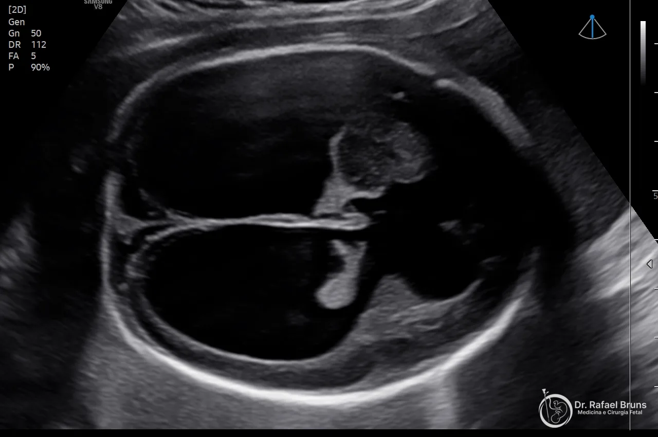 Ventriculomegalia fetal: o que significa ventrículos dilatados no ultrassom